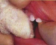 Aplicação de flúor dentes mais fortes e saudáveis Aplicação de flúor dentes mais fortes e saudáveis